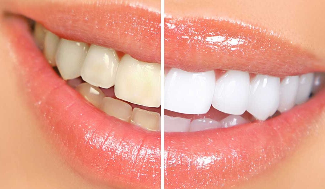 Teeth whitening