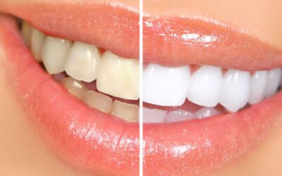 Teeth whitening