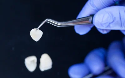 Veneers on Teeth- a popular choice for a natural smile