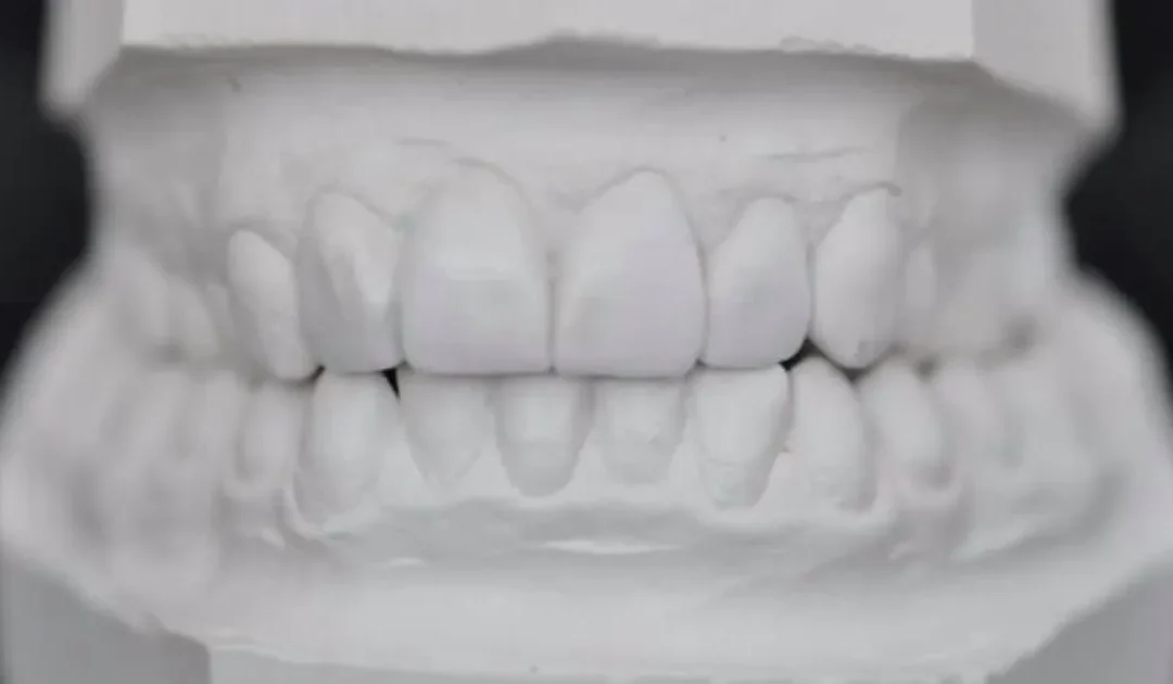 Bruxism: att gnissla tänder